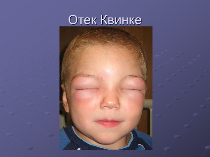 Отек Квинке